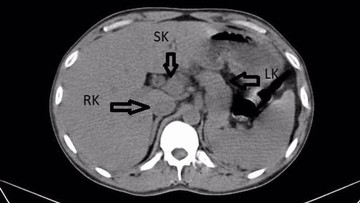 Kasus Medis Langka: Pria India Ditemukan Memiliki Organ Ginjal Ekstra Berbentuk Tapal Kuda